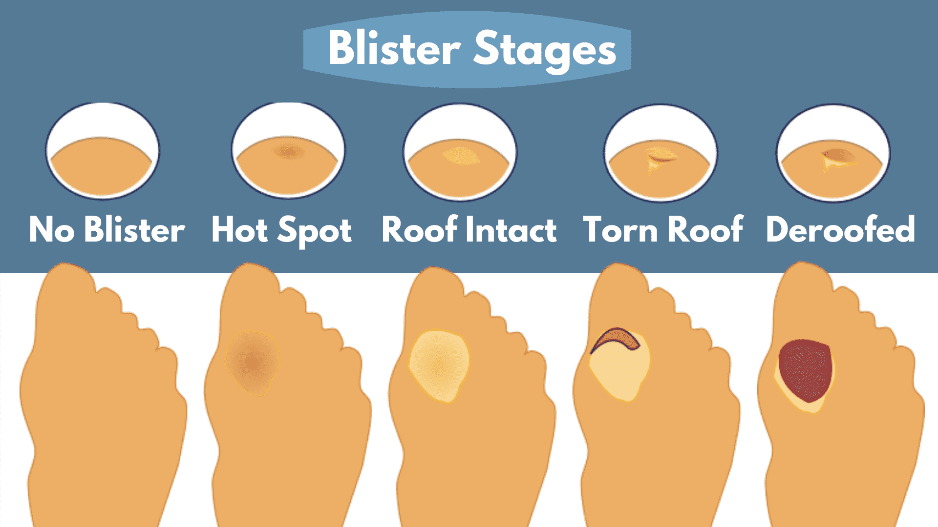 Preventing Blisters While Hiking Treating Blisters The Easy Way The