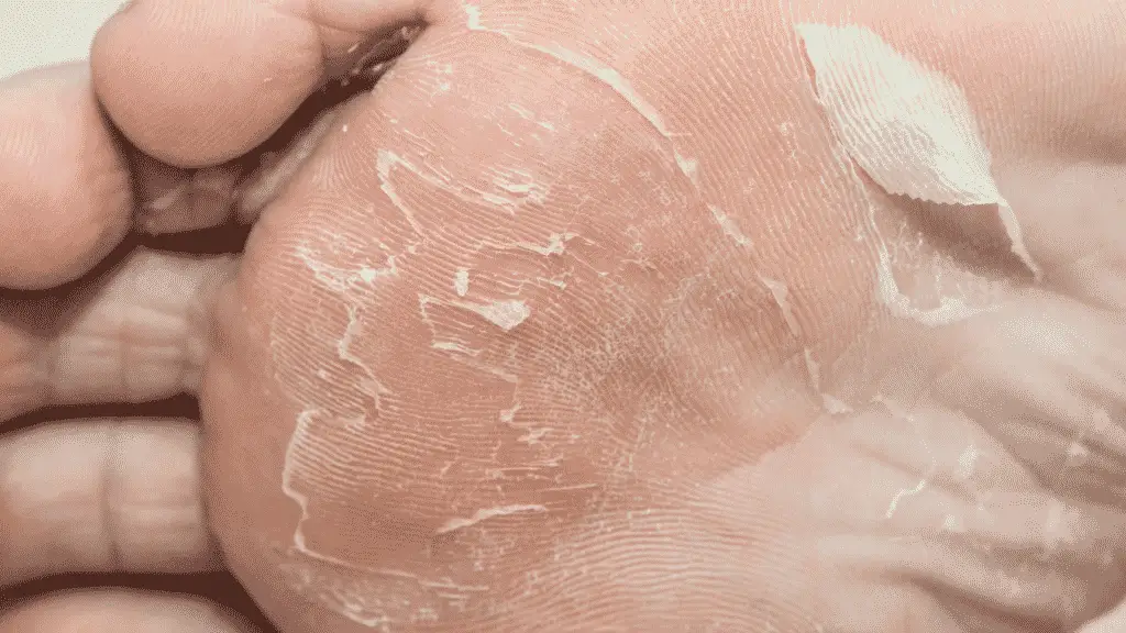 Blisters are one of the most common hiking injuries.